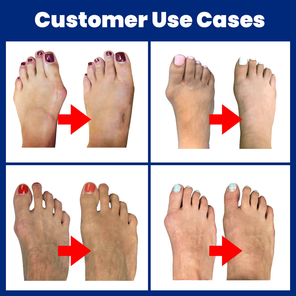 Bunifix - Bunion Corrector 